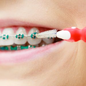 Woman with teeth braces using interdental brush Dentist and orthodontist concept. Young woman with blue braces cleaning and brushing teeth using little toothbrush, interdental brush